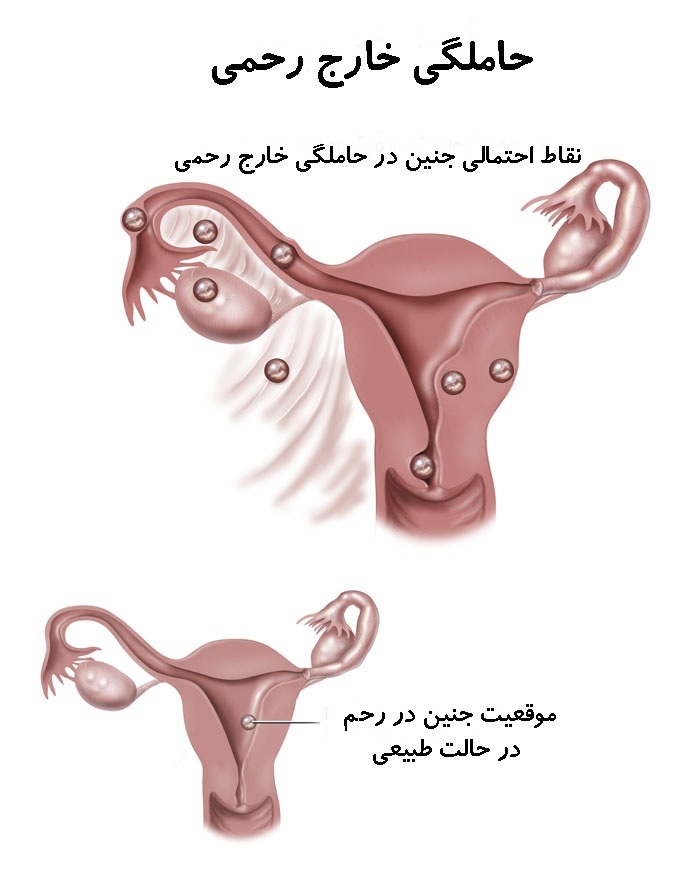 Ectopic Pregnancy01